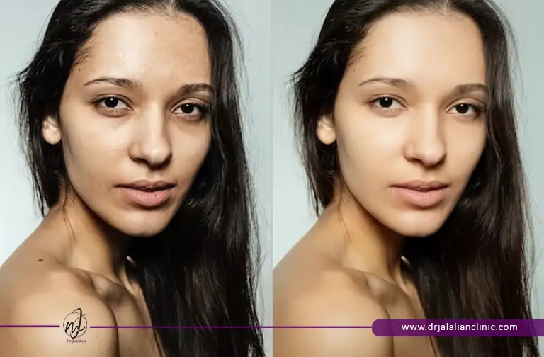 قبل و بعد از تزریق ژل زیر چشم