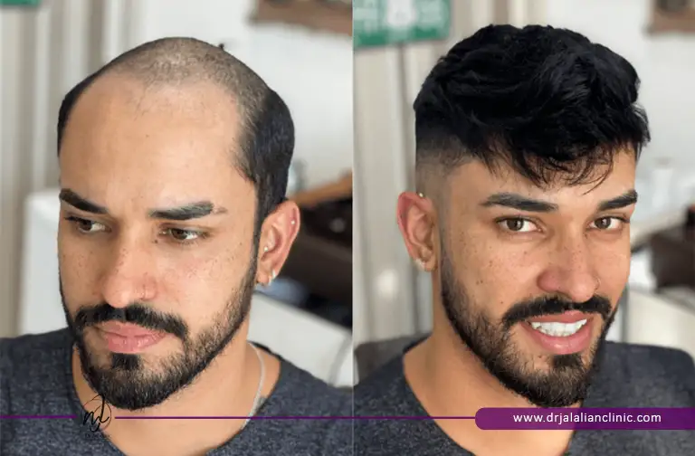 قبل و بعد پروتز مو